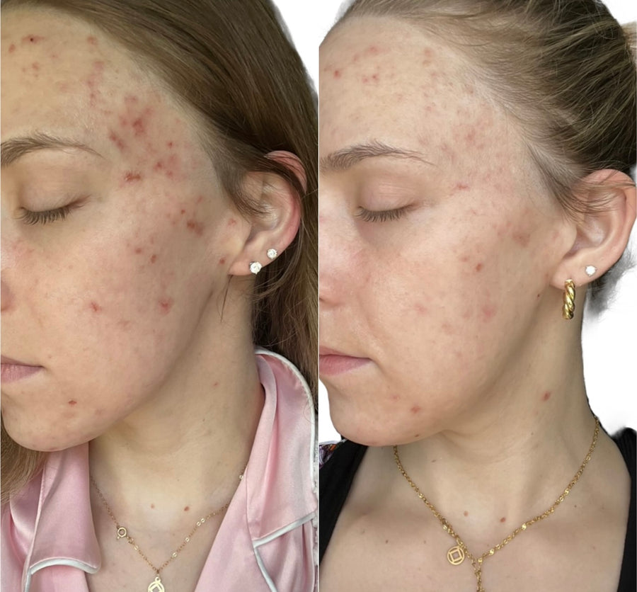 XF LED FACIAL MASK (light therapy at home)