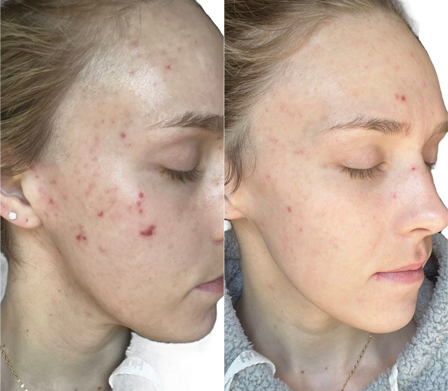 XF LED FACIAL MASK (light therapy at home)