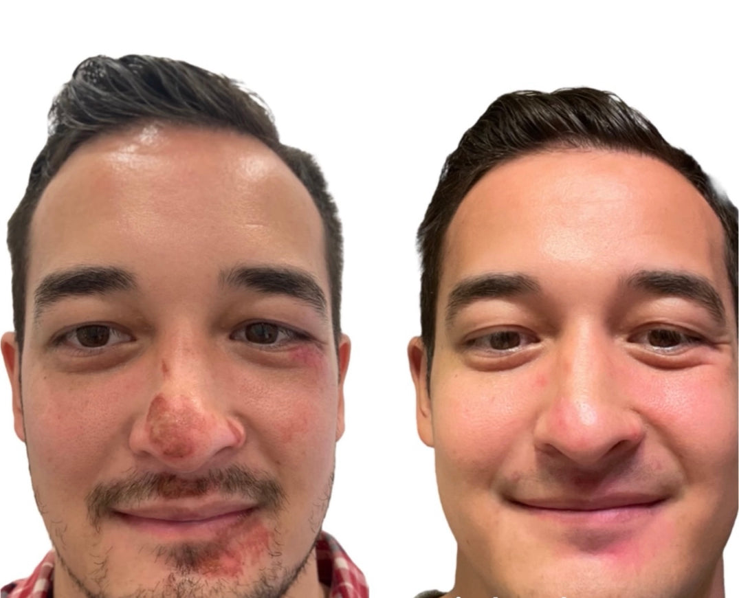 XF LED FACIAL MASK (light therapy at home)